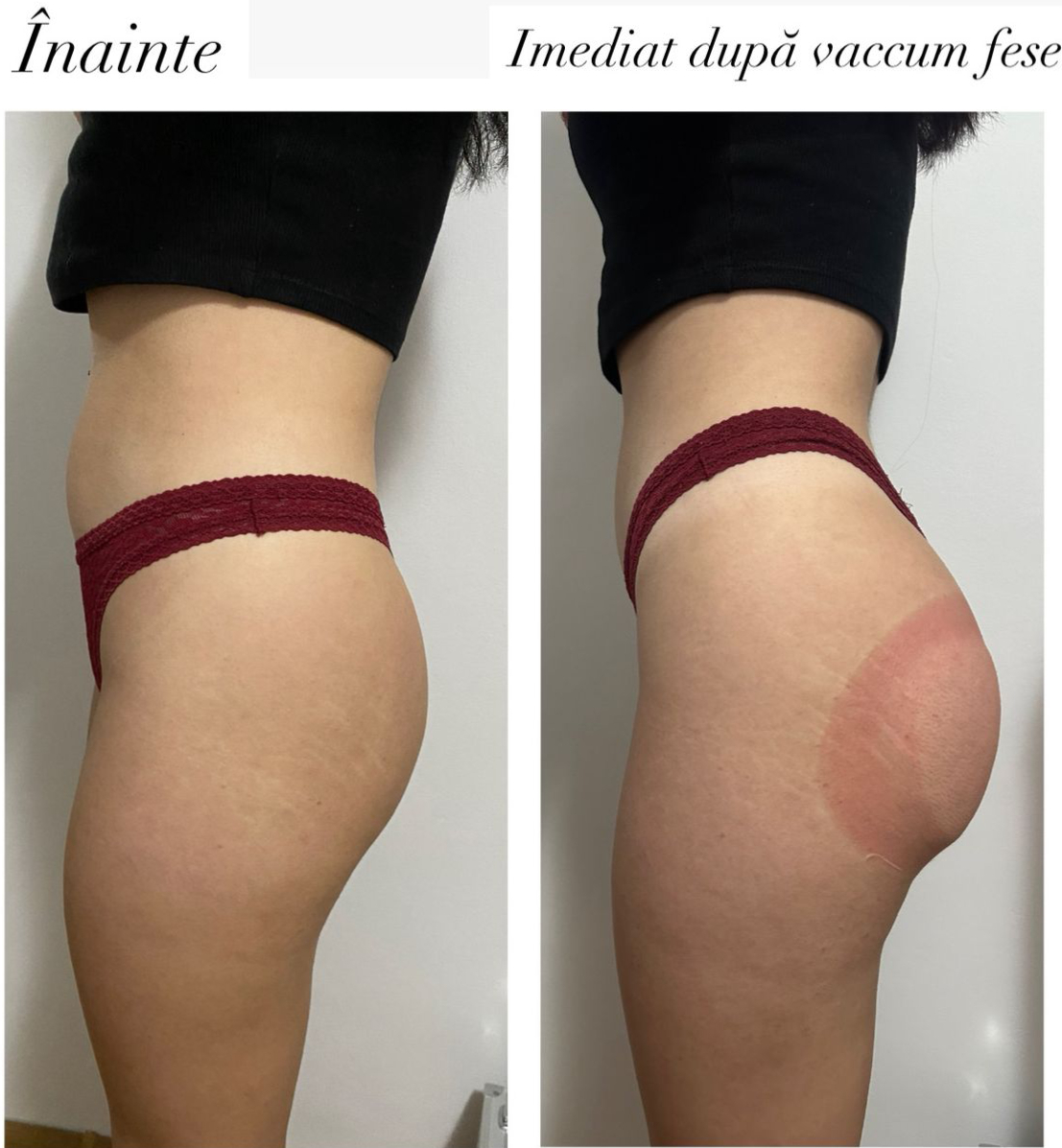 Vacuum Fese – lifting imediat