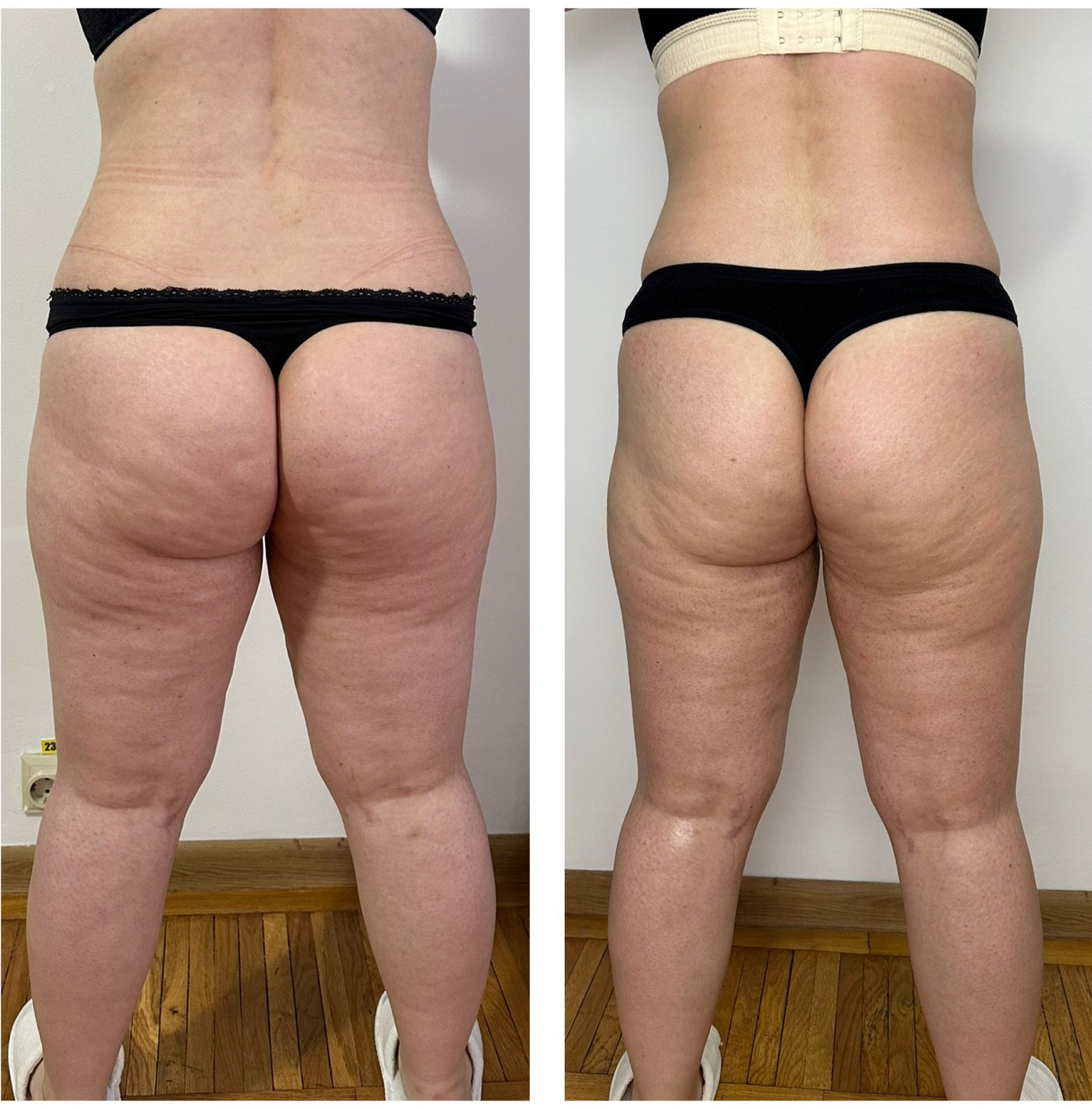 Remodelare – coapse si picioare