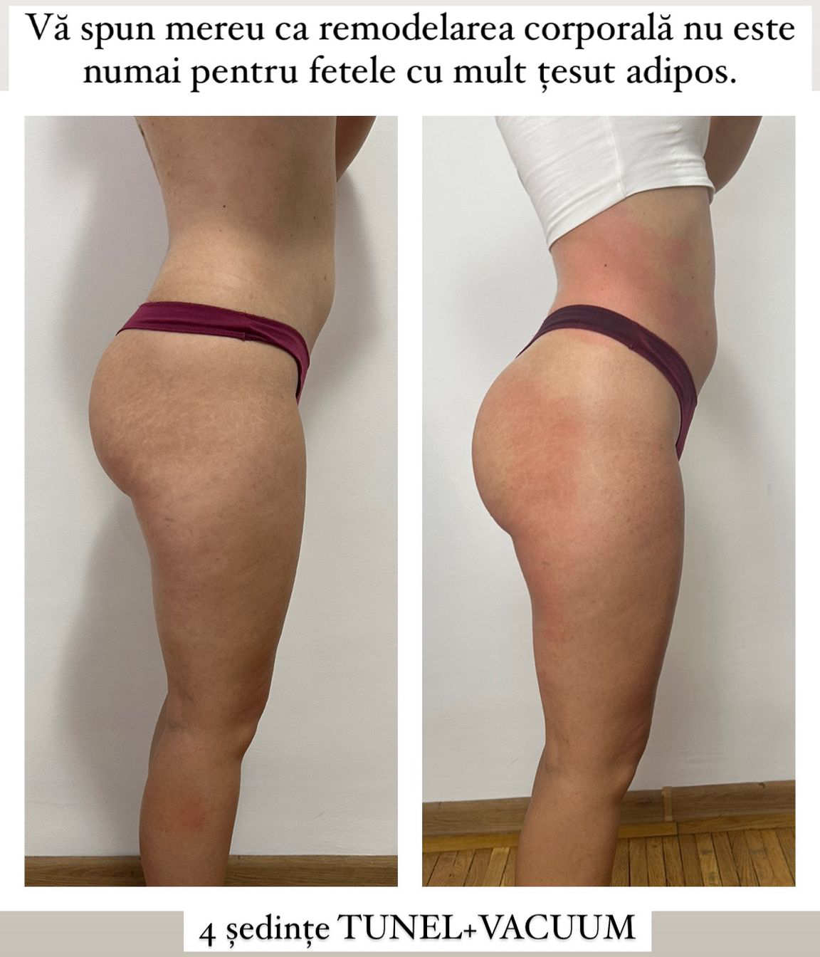 Tunel + Vacuum 4 sedinte