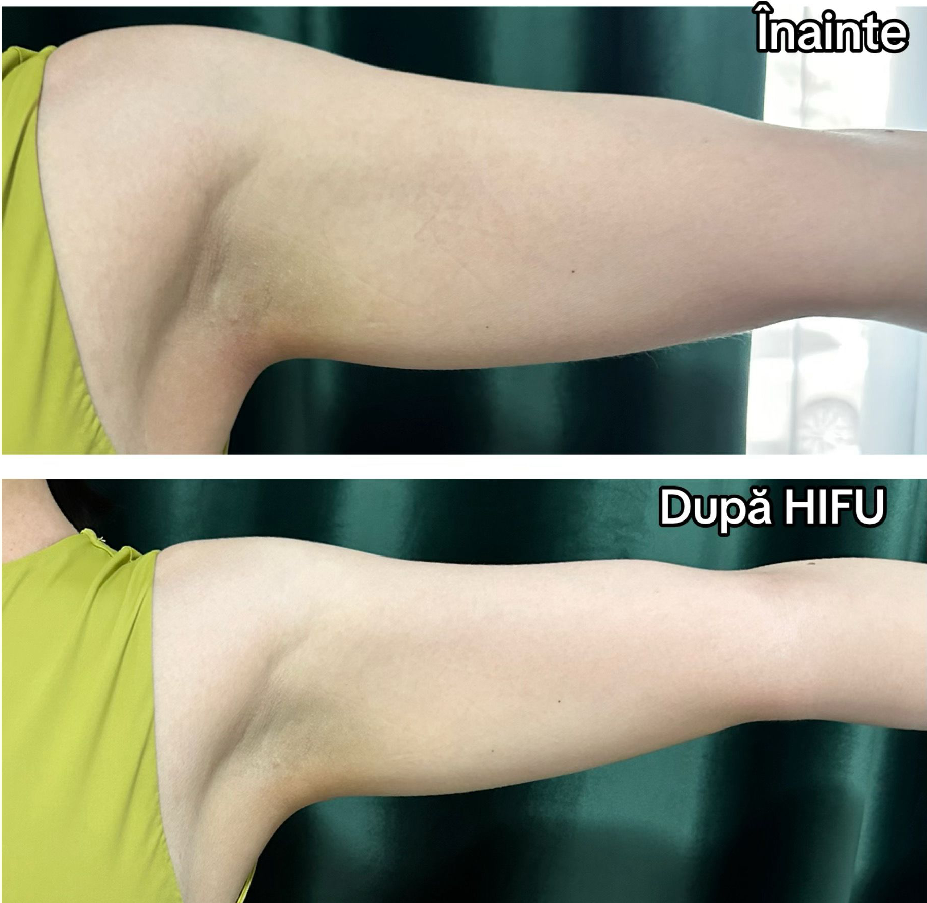 HIFU Brațe – fermitate