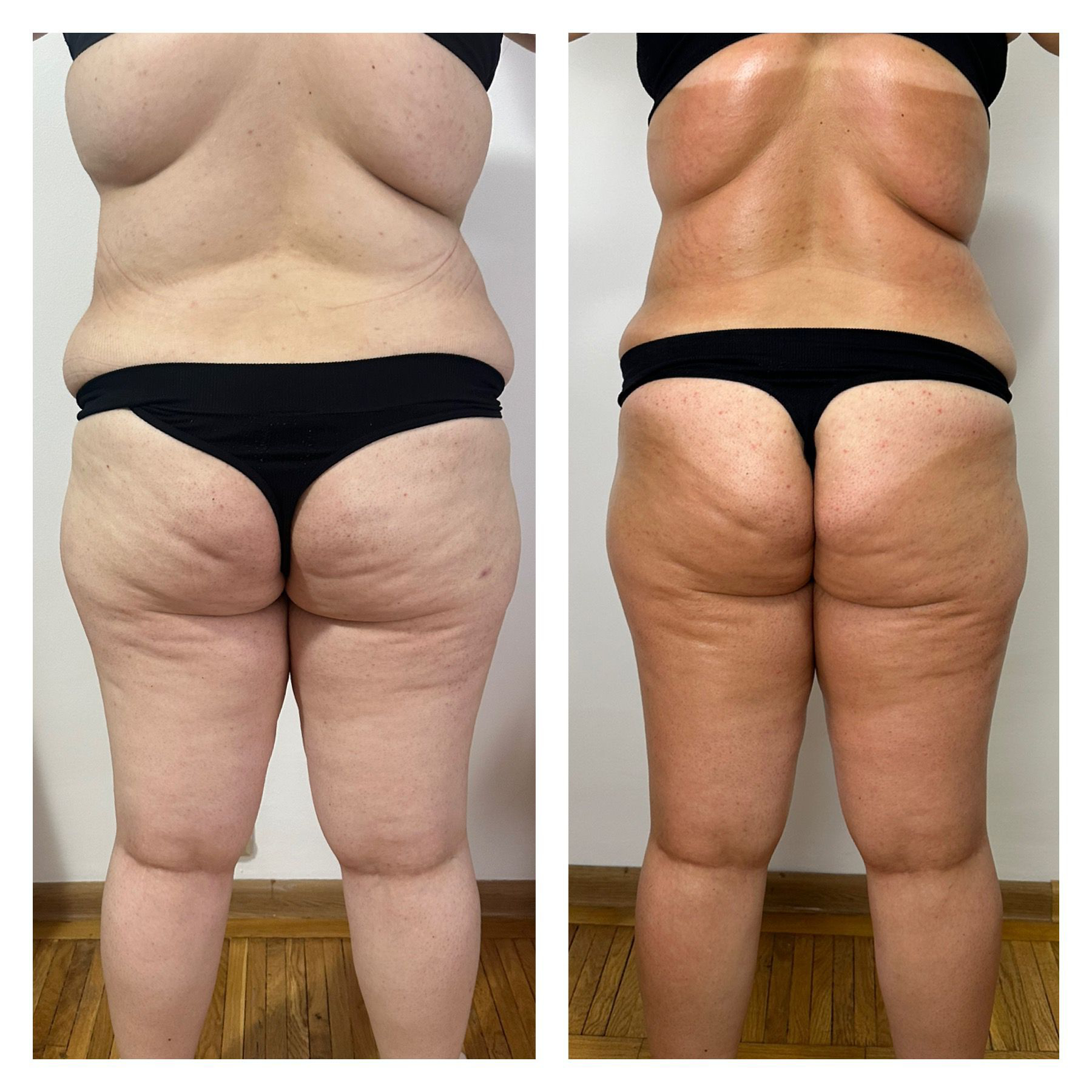 Remodelare – corp complet